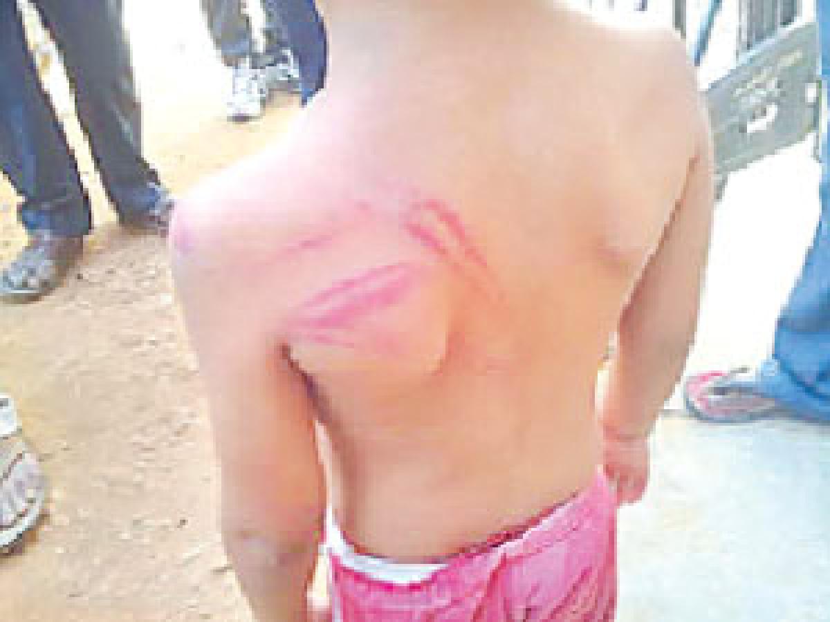 Teacher beats LKG student with steel scale