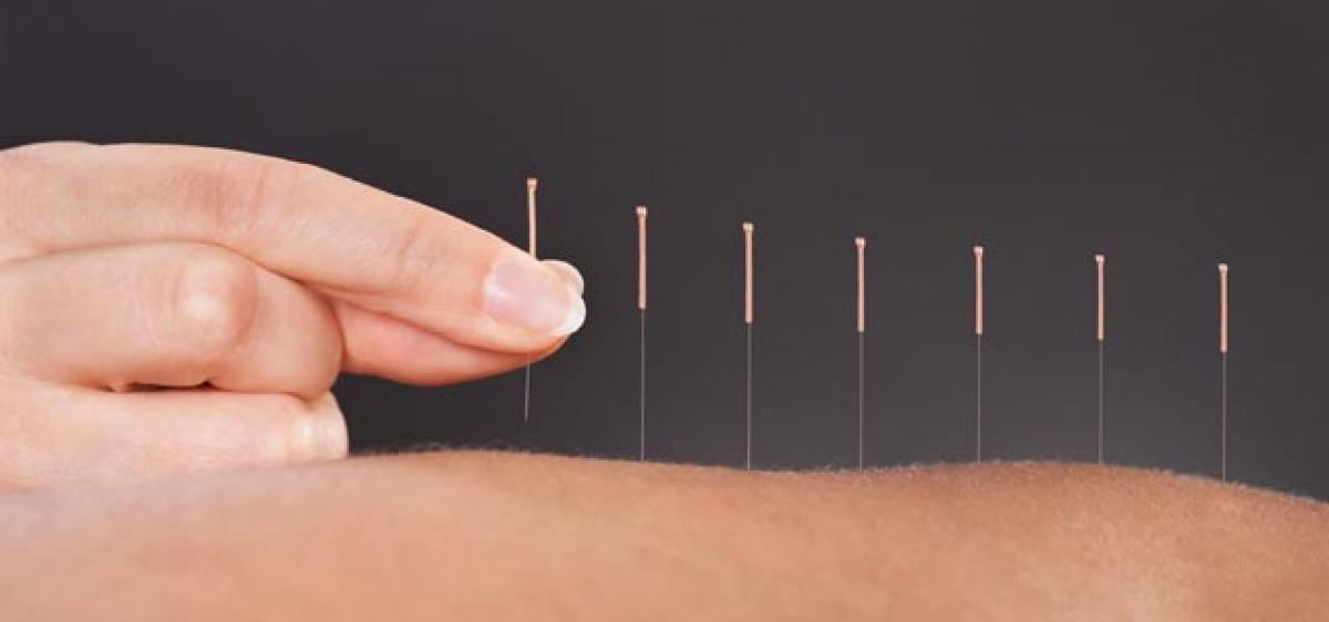 Acupuncture can help reduce chronic pain, depression