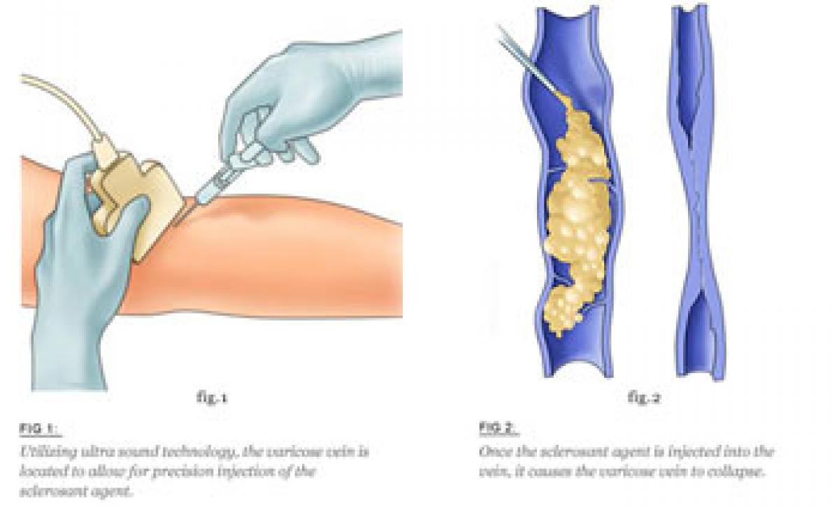 Modern Laser Ablation Treatment For Varicose Veins