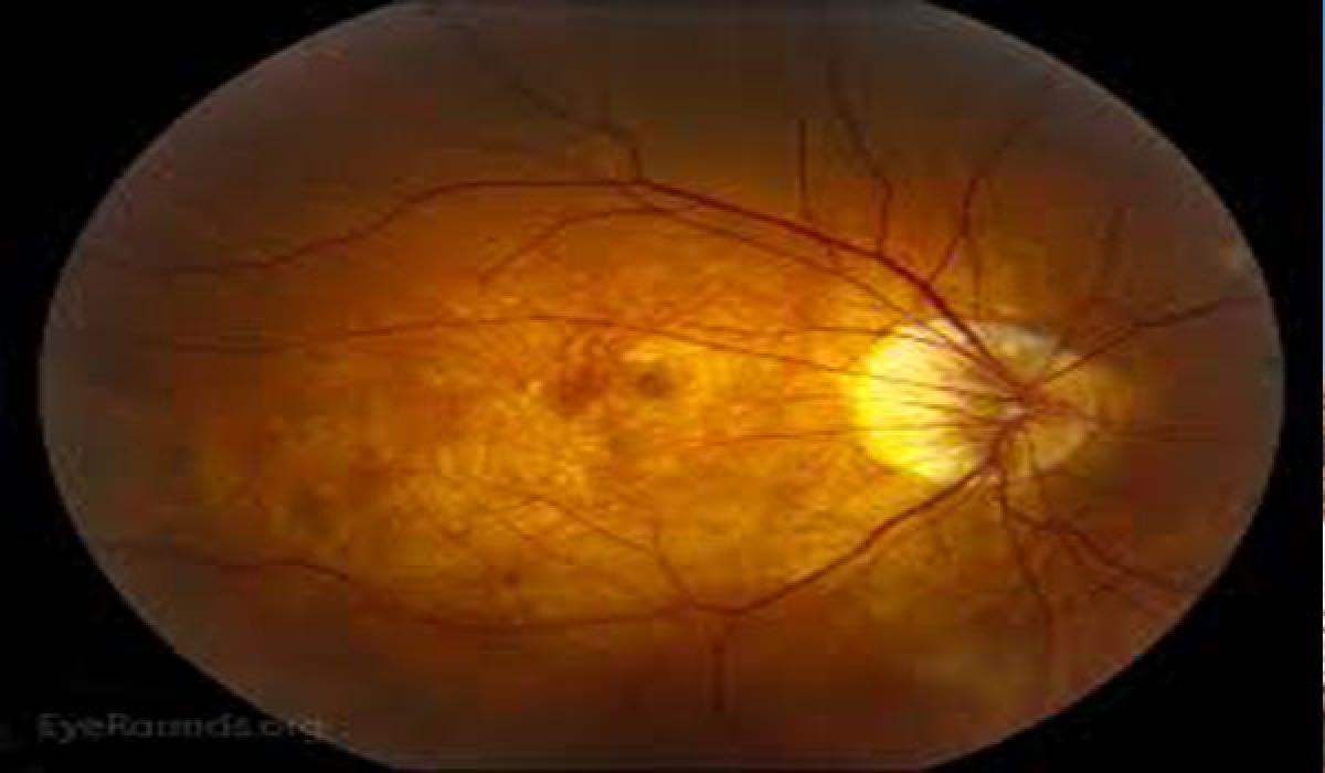 Generic glaucoma drug to halt myopia progression