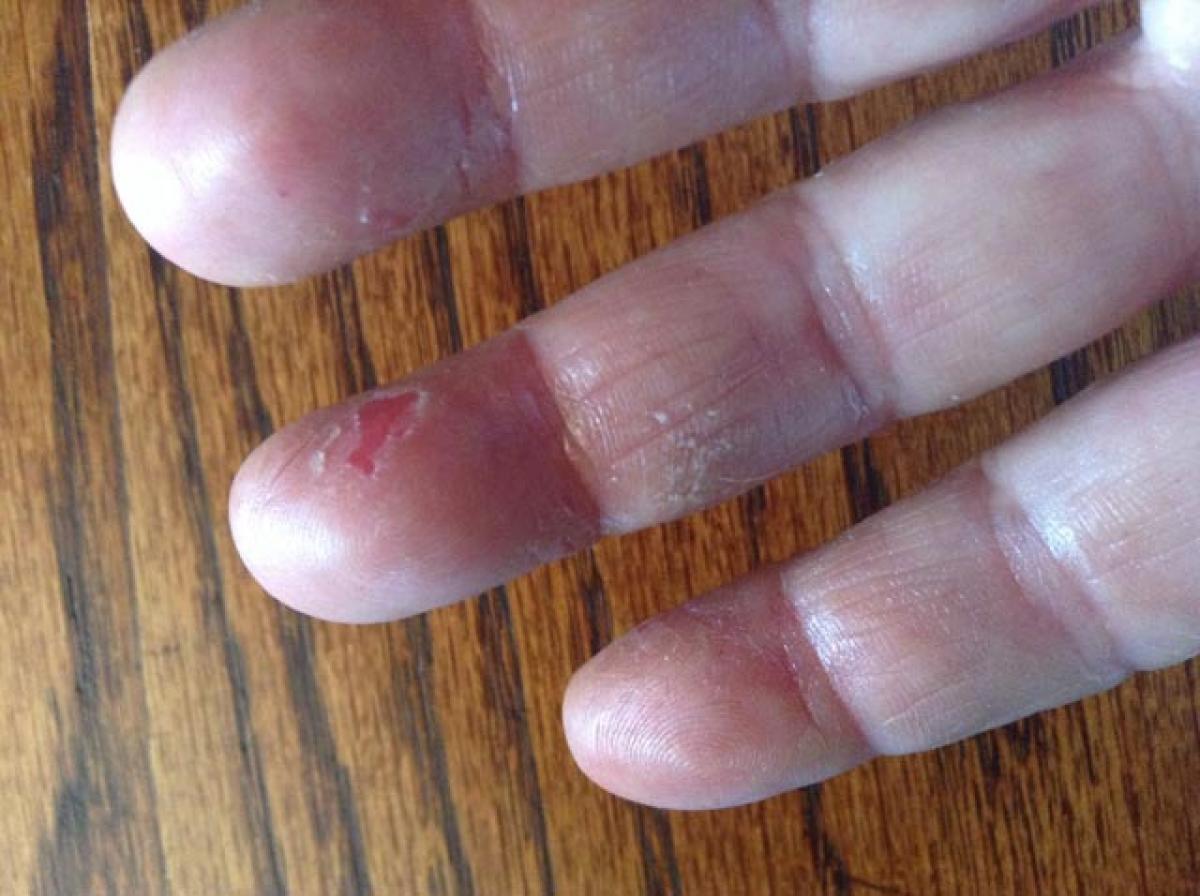 Solution to peeling fingertips 