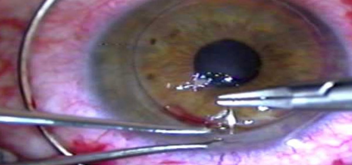 Doctors conduct cornea transplant for first time in Khammam
