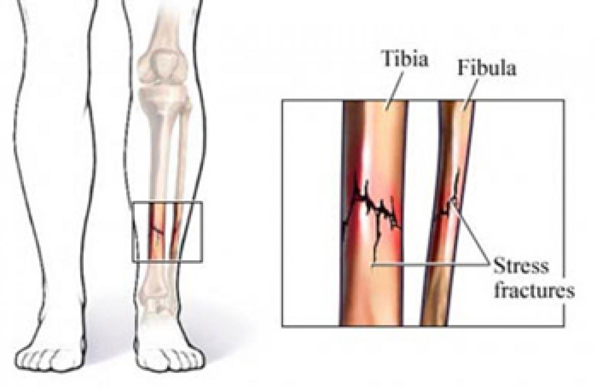 Genes influence stress fracture injuries