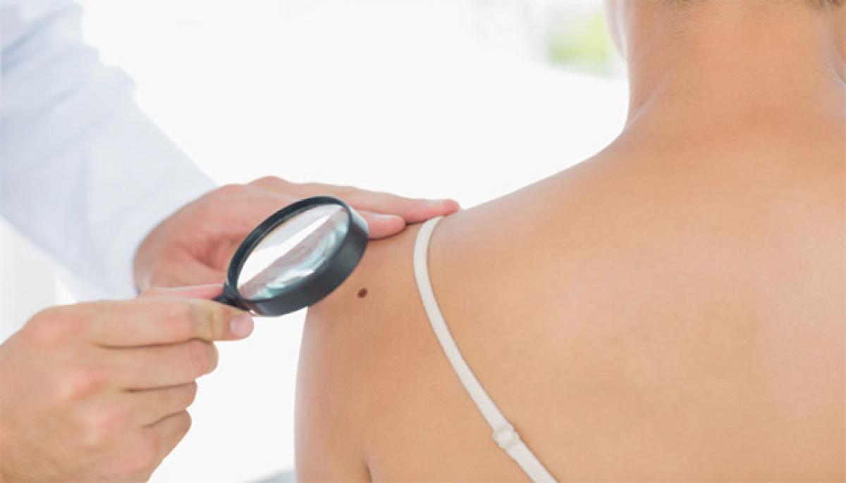 Why moles develop into skin cancer