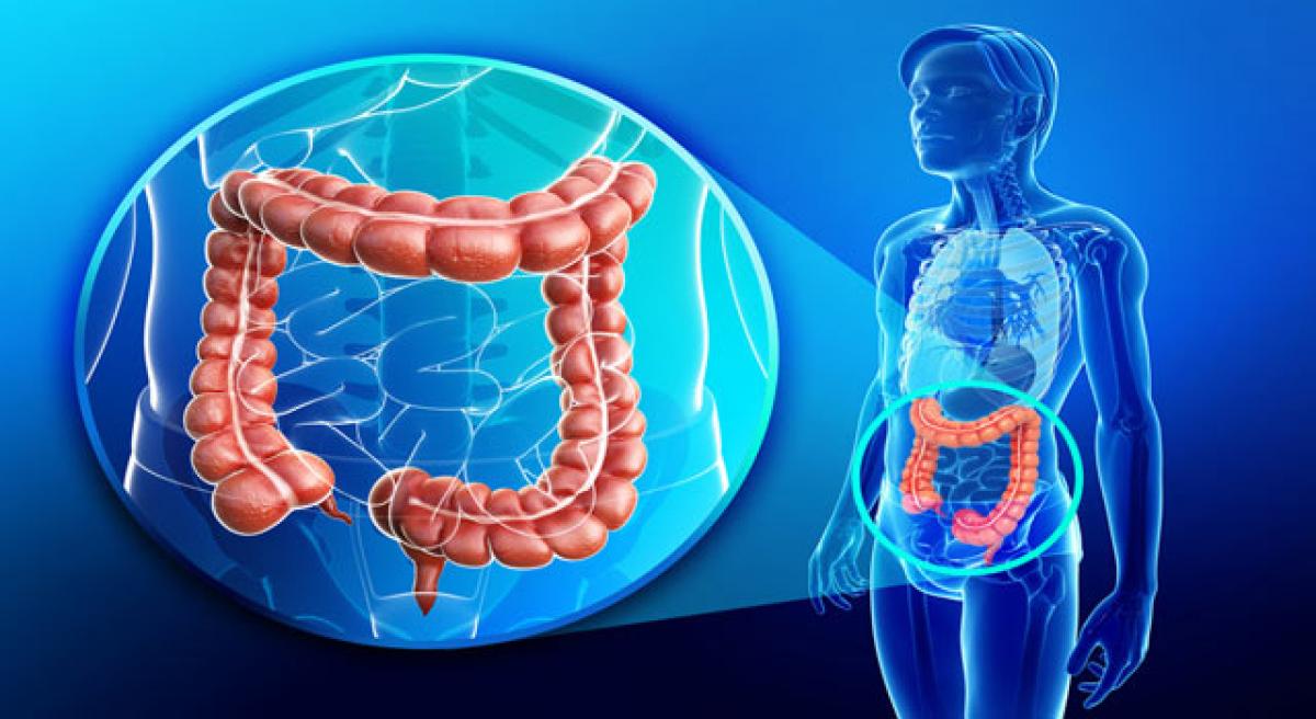 Everything you need to know about colorectal cancers