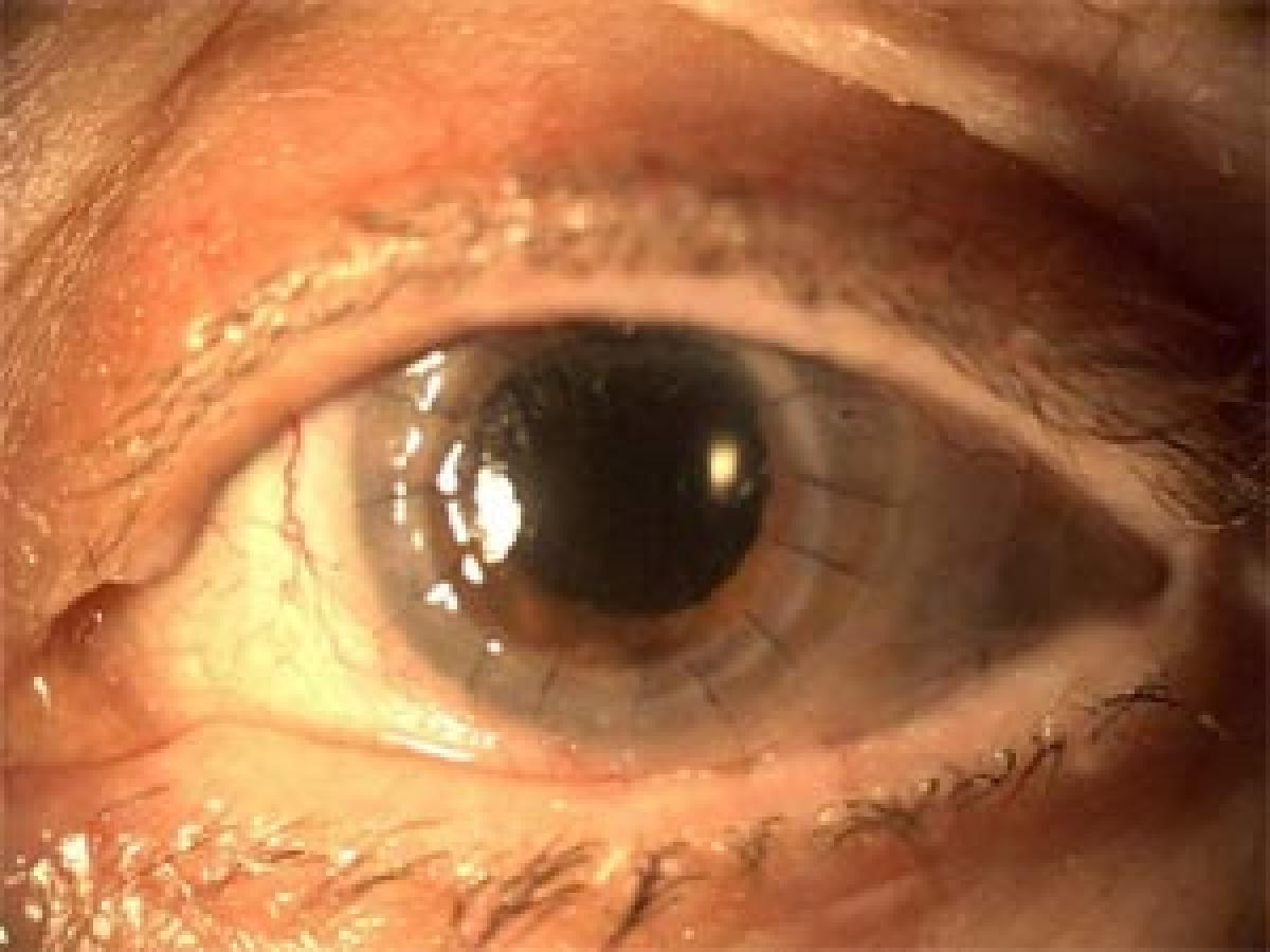 Patient undergoes cornea transplant 