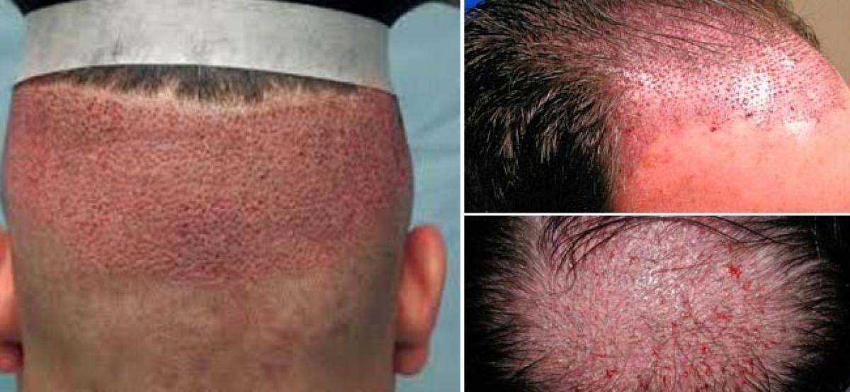 Are There Any SideEffects After Hair Transplantation  ALCS  Cosmetic  Surgery  Hair Transplant In Jaipur