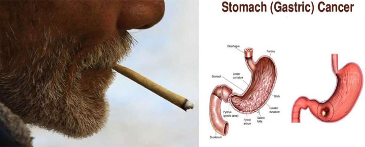 Gastric cancer could be a result of smoking beedis