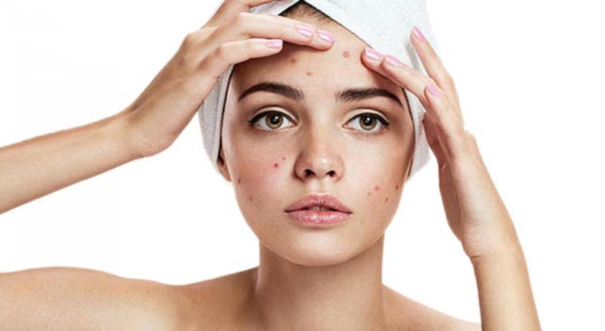 Beat summer acne using simple tips
