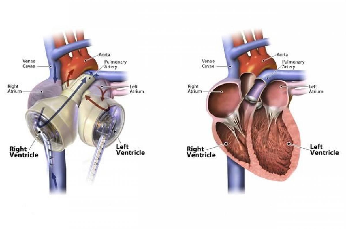 Smaller heart transplant successful