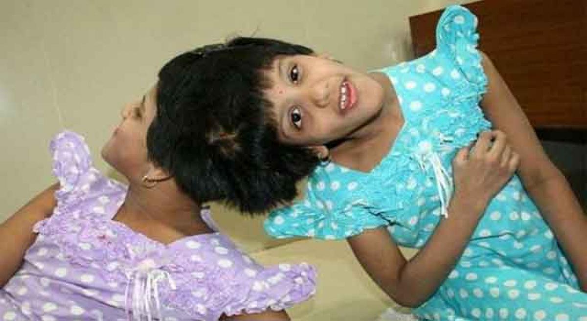 Conjoined twins parents relent, agree for surgery