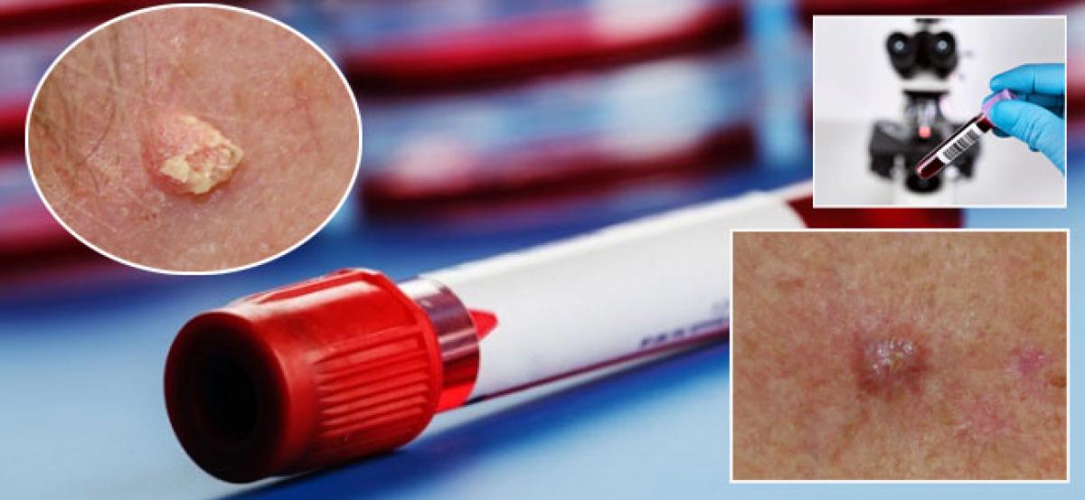 New blood test to quickly diagnose skin cancer