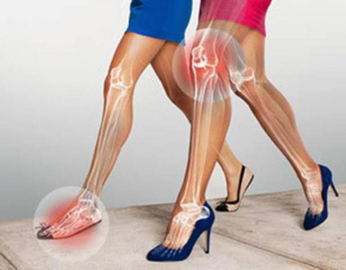 Excess use of high heels causes osteoarthritis