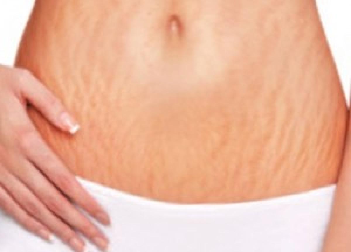 How to erase stretch marks post pregnancy