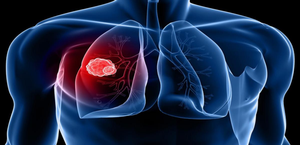 Autoantibodies may lead to early detection of lung cancer