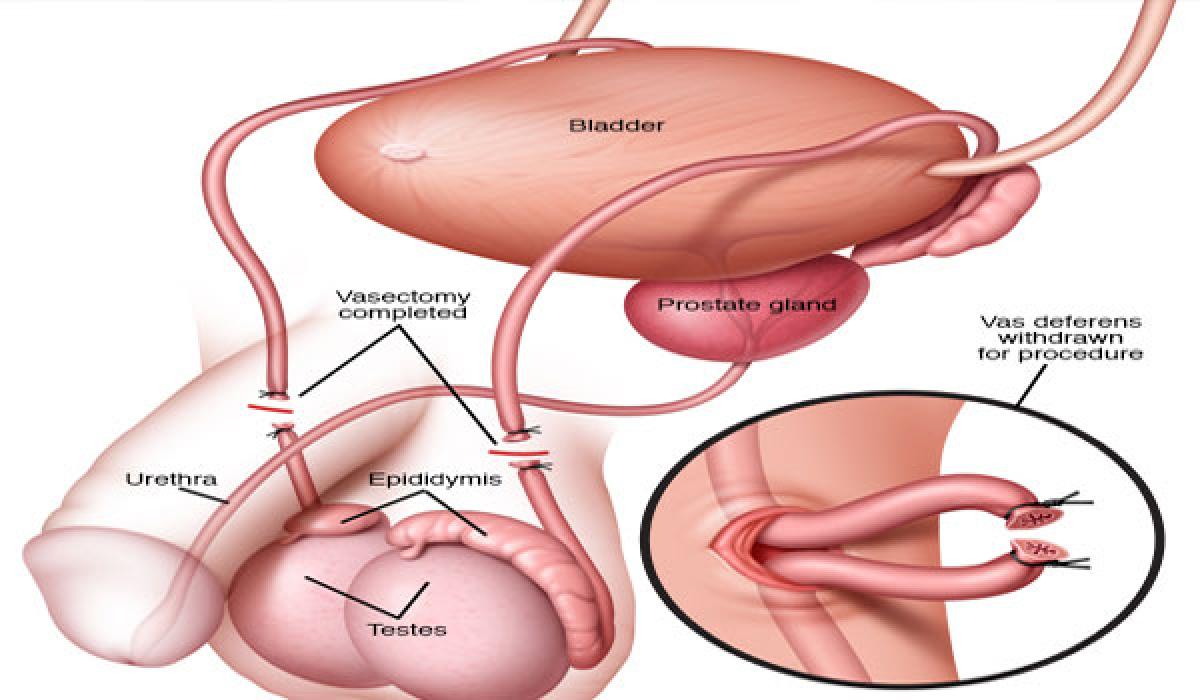 Men shy away from vasectomy