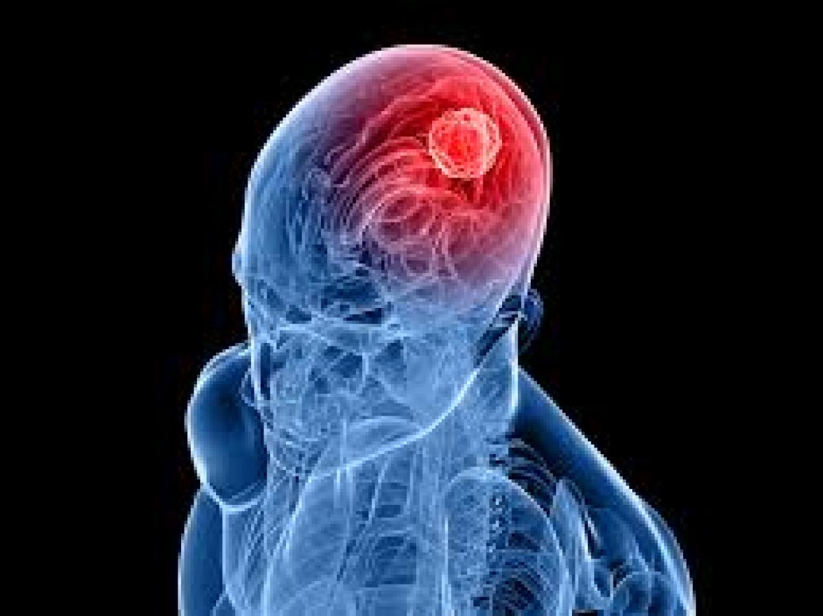 Genes associated to brain tumour identified