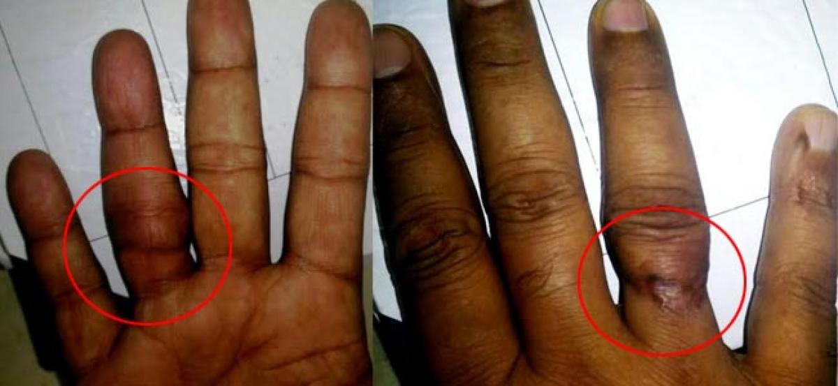 Severed finger of RPF serviceman reattached at NSSH through finger revascularization surgery
