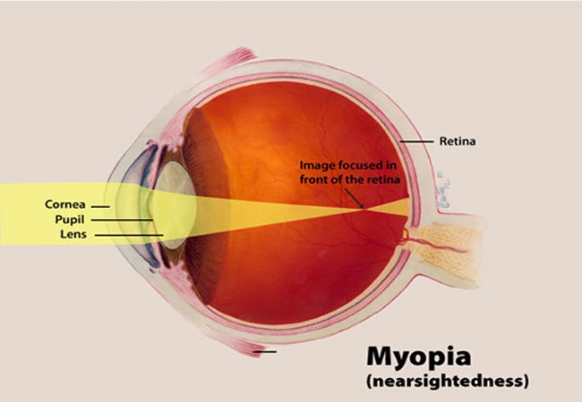 Half the worlds population to be myopic by 2050