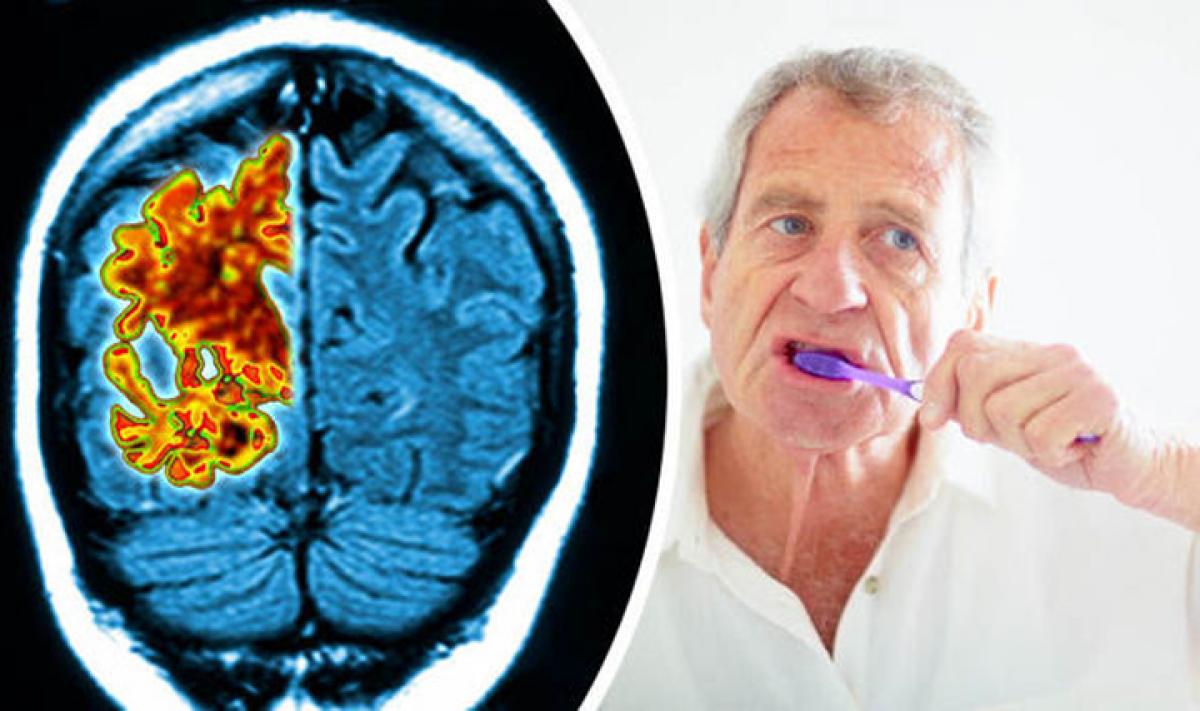 Gum disease linked with memory decline in Alzheimers