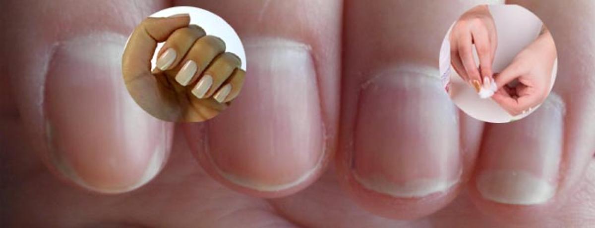 White Spots On The Nails Full Guide - RemoteDerm