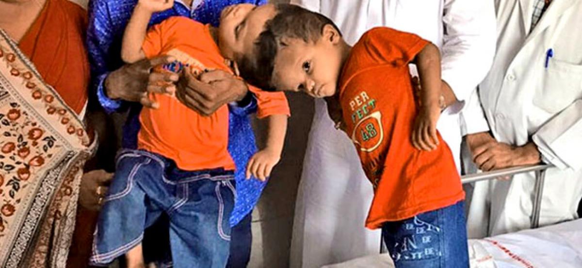 30 per cent surgery of conjoined twins completed; condition stable: AIIMS doctor