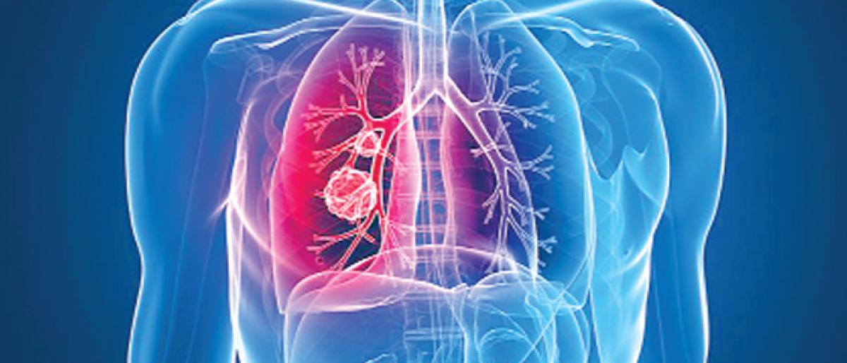 This AI system spots often-missed lung cancer tumours