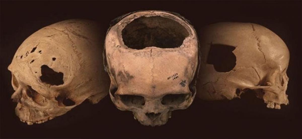 Ancient Peru’s cranial surgeons highly skilled: Study