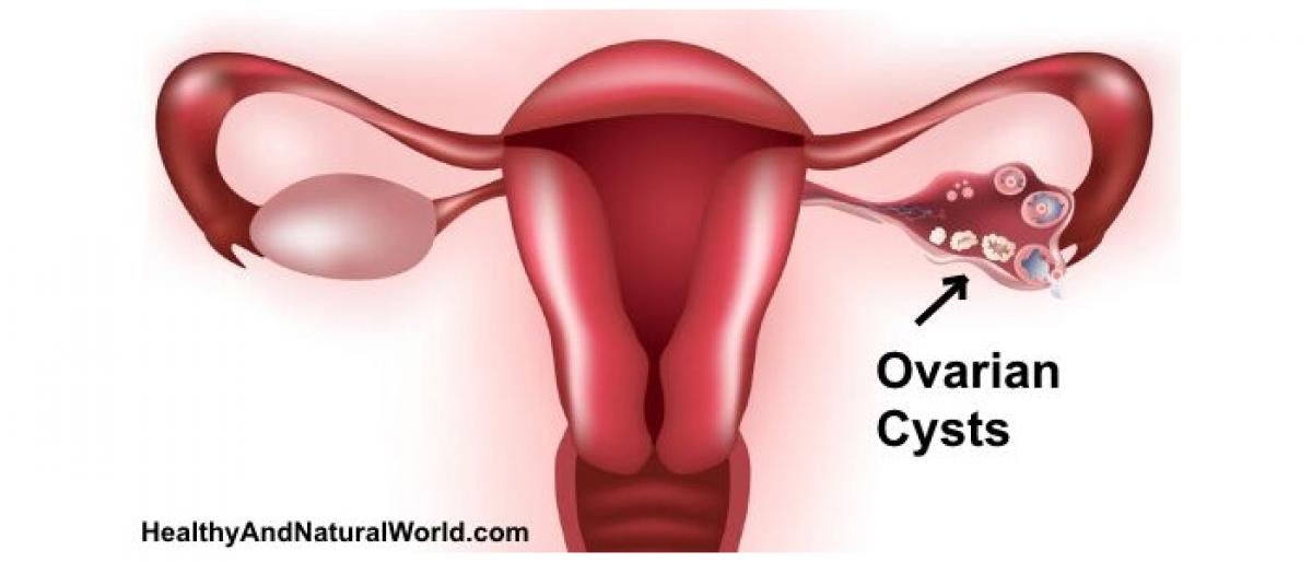 Simple ovarian cysts don’t require surgical removal: Study