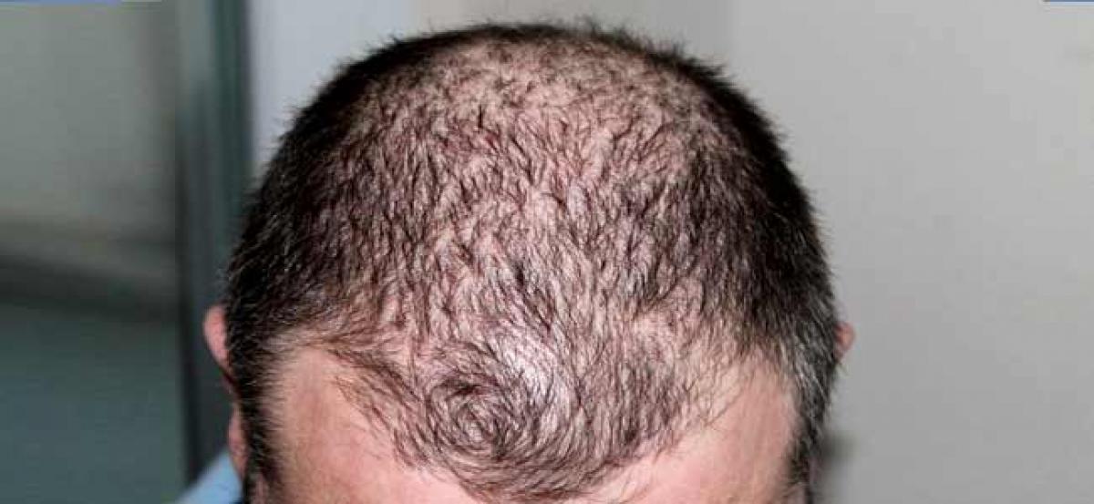 Early baldness, greying of hair ups heart disease risk in men