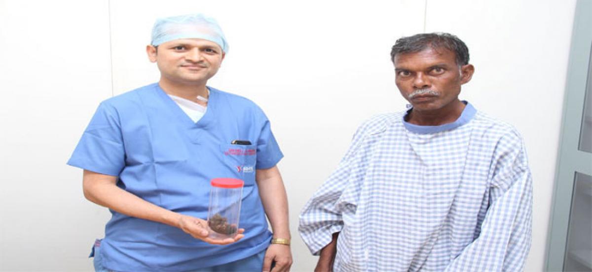 Potato-sized stone removed from kidney at KIMS Hospitals
