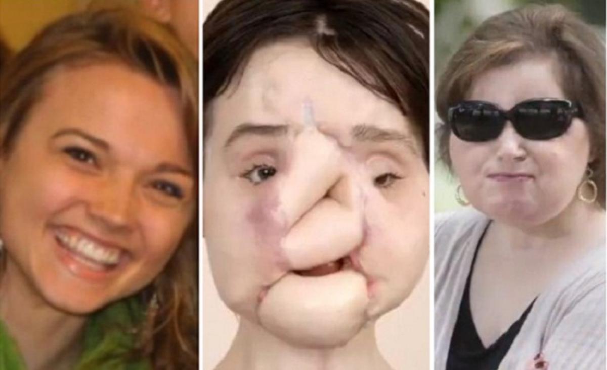 21-year-old suicide survivor undergoes historic face transplant