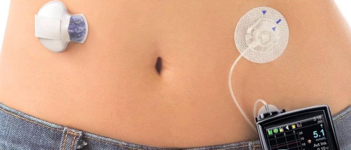 Artificial pancreas system better than insulin jabs for diabetics