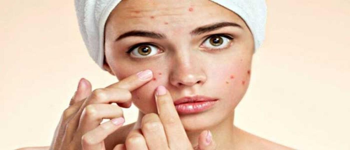 Don’t let acne trouble you
