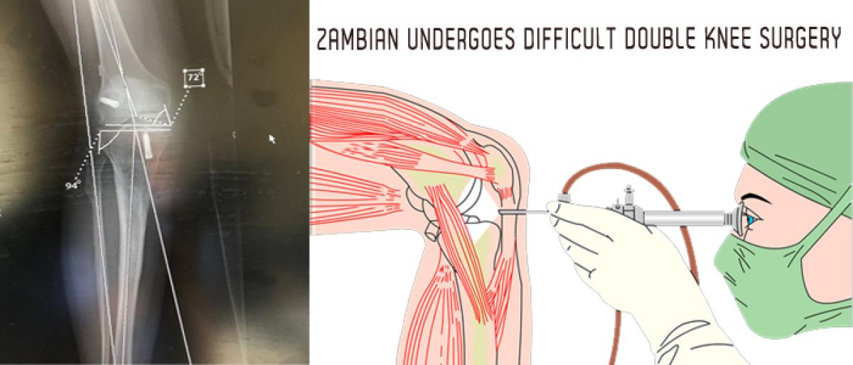 Zambian undergoes difficult double knee surgery in New Delhi