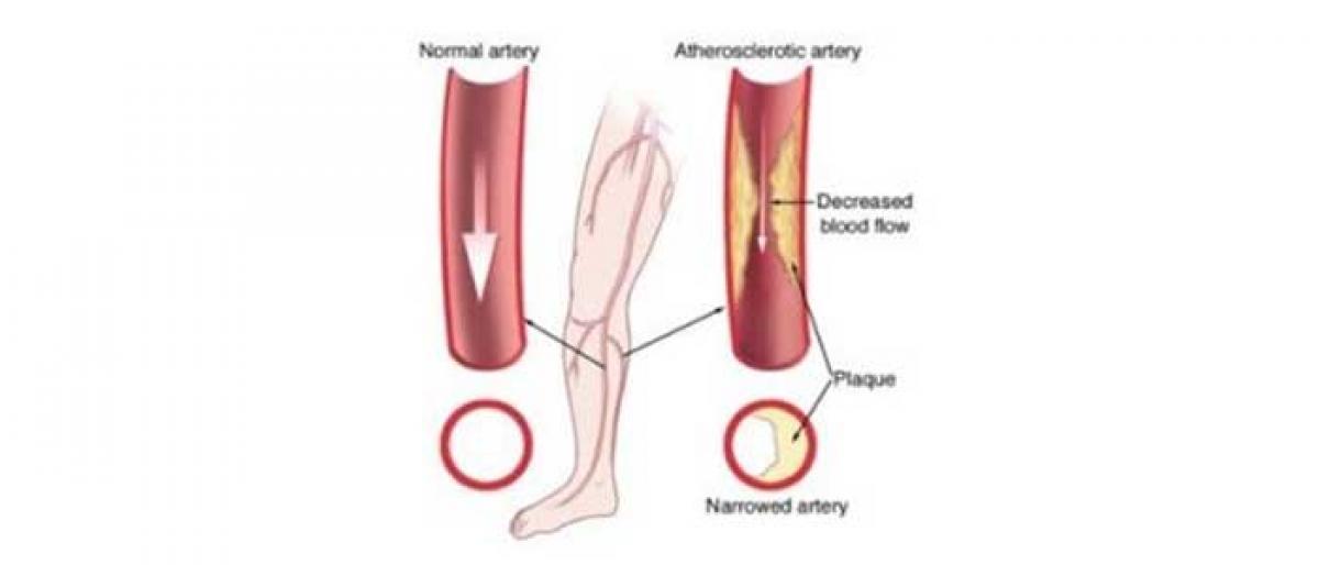 Vascular disease, a silent killer