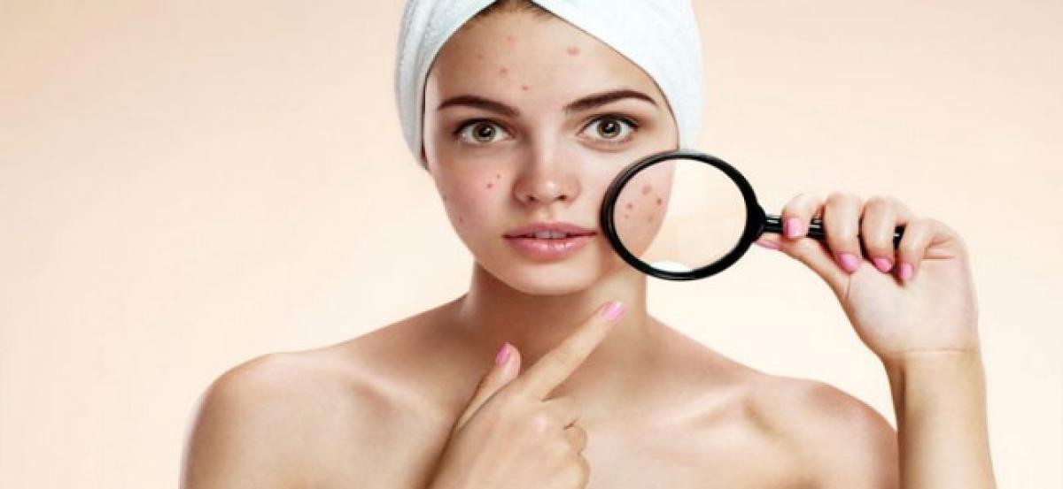 How to ban the Teenage Acne with home remedies