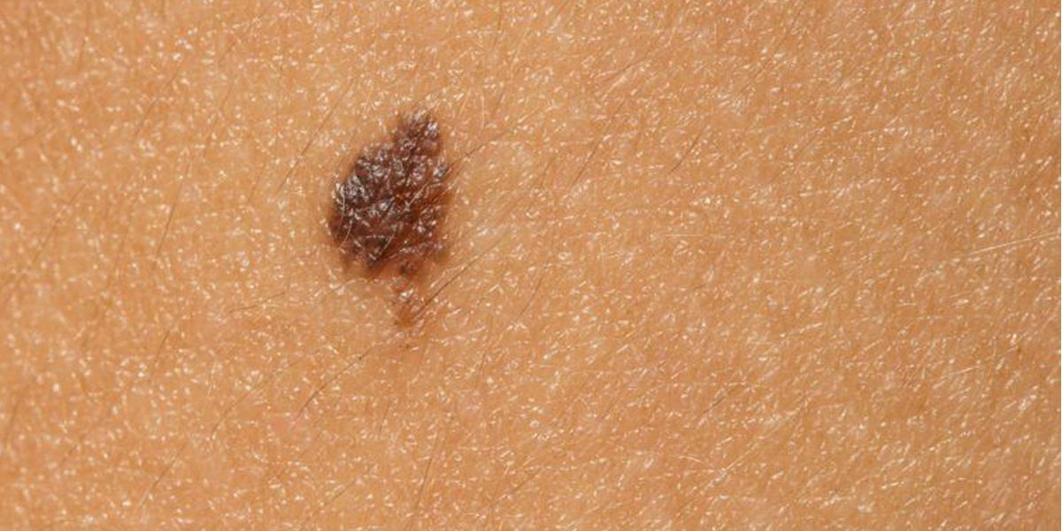 Protein linked to skin cancer identified