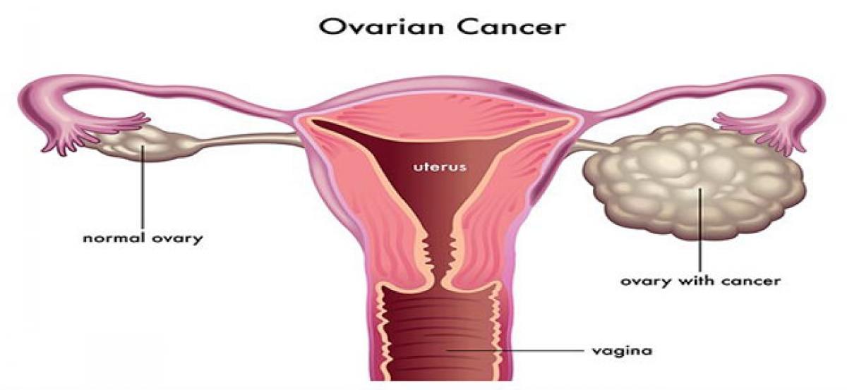 Girls may inherit ovarian cancer gene from fathers