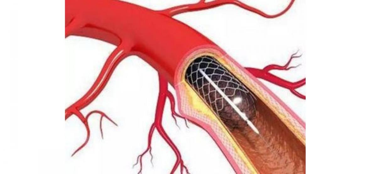 NPPA revises cardiac stent price cap