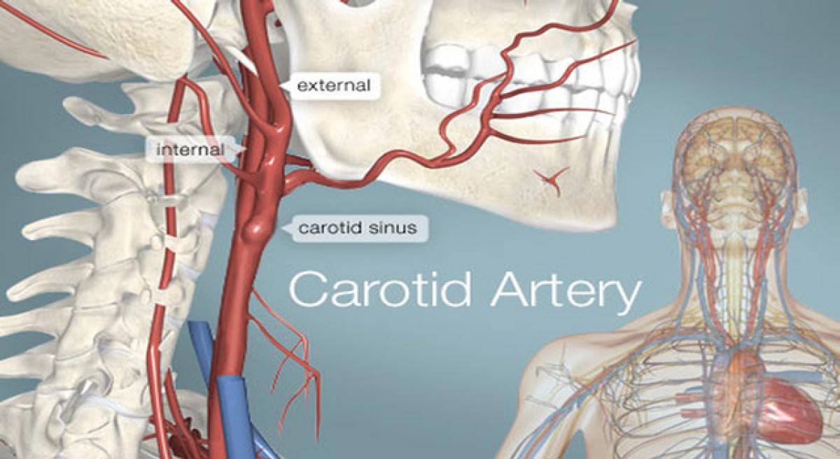 A stroke risk reduction surgery