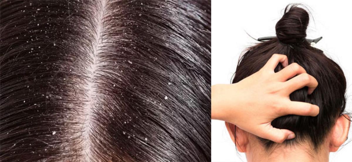 Lets treat dandruff problems at Home