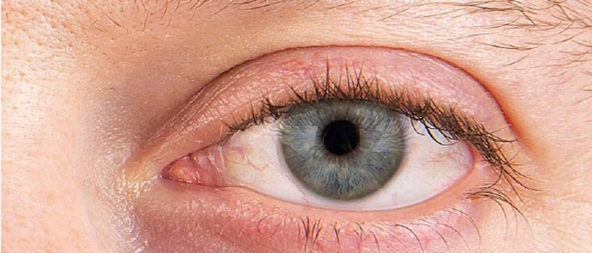 Facts about dry eye syndrome