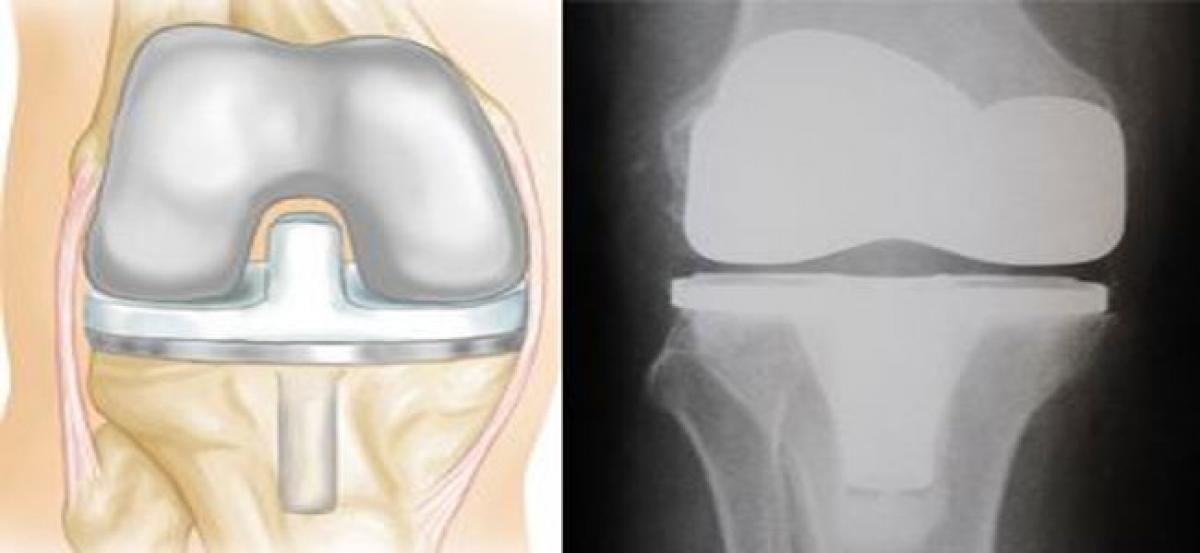Novel technique for knee replacements