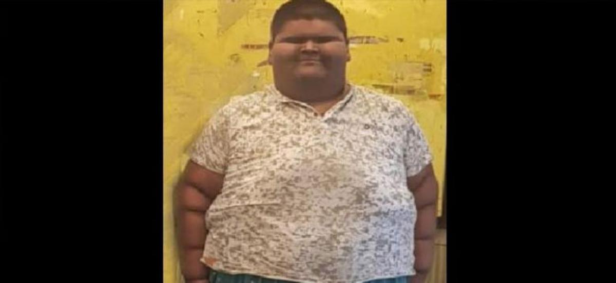 Once worlds heaviest teen at 237 kg, Delhi boy undergoes weight-loss surgery