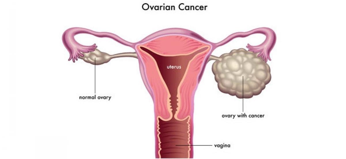Most ovarian cancers start in fallopian tubes: Study