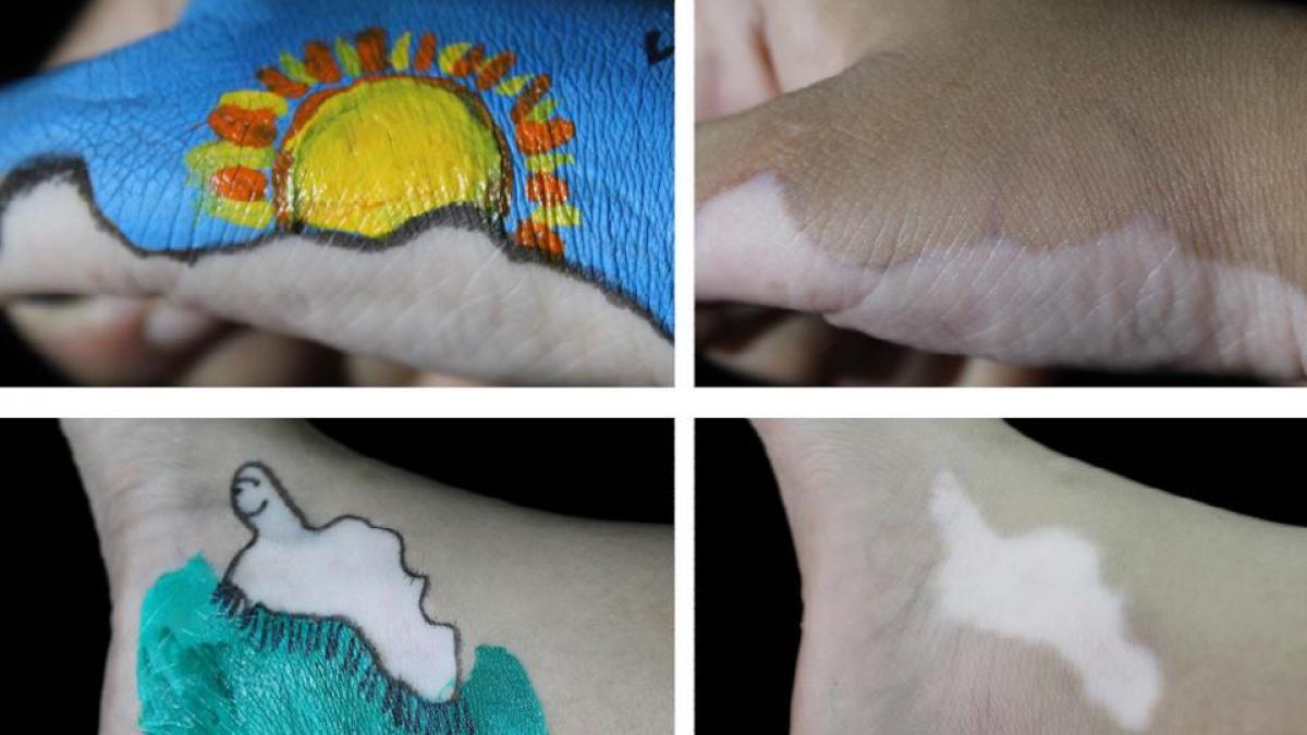 Body of art: This 17-year-old paints her vitiligo patches to battle stigma