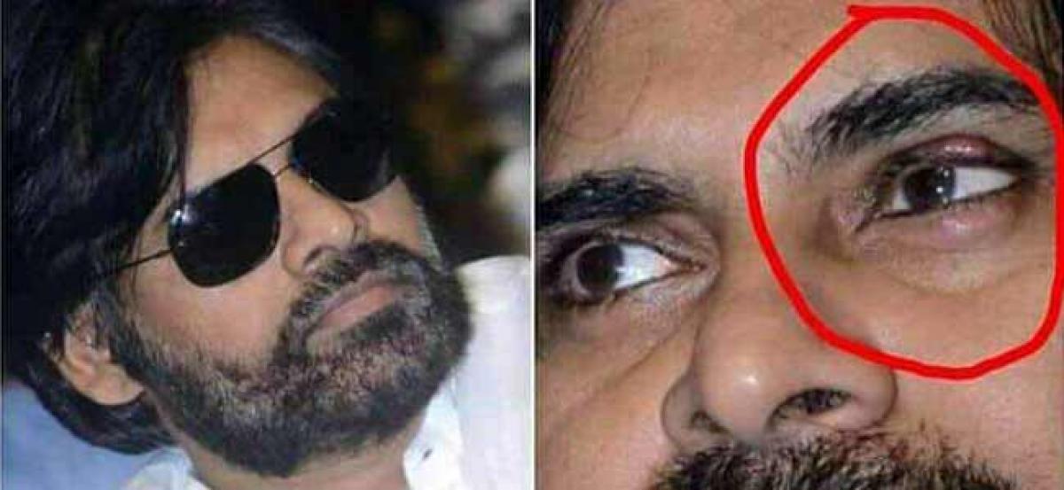 Pawan Kalyan Undergoes Eye Surgery Again