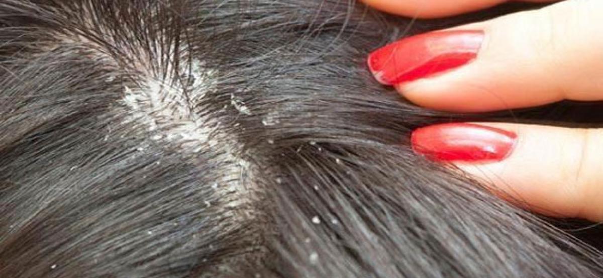 Scalp control home remedies