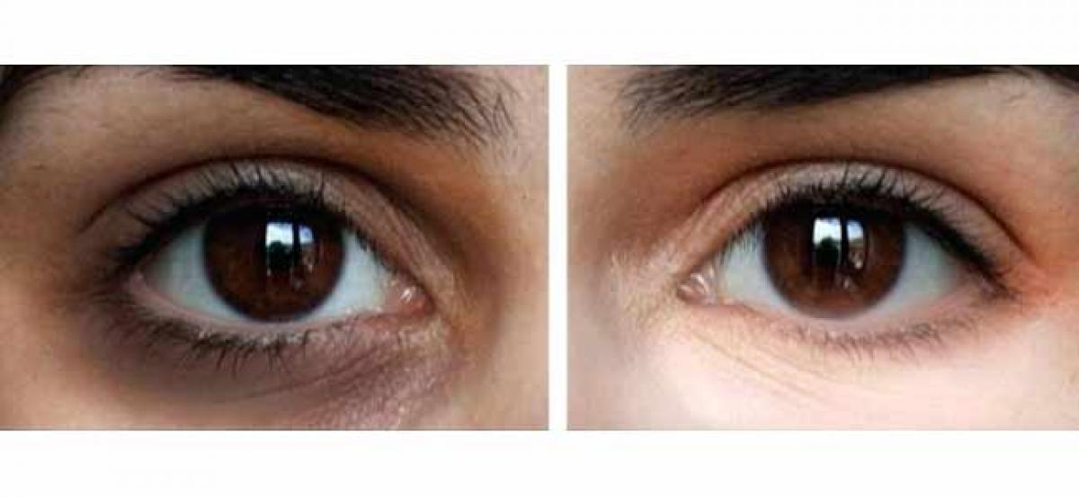 Is there a way to permanently get rid of dark circles?